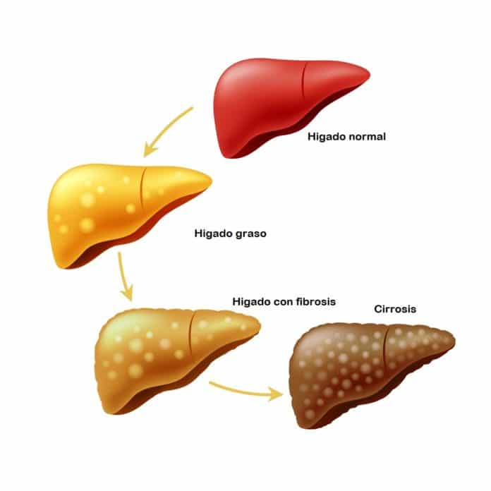 La esteatosis hepática no causa molestias en sus primeros estadios