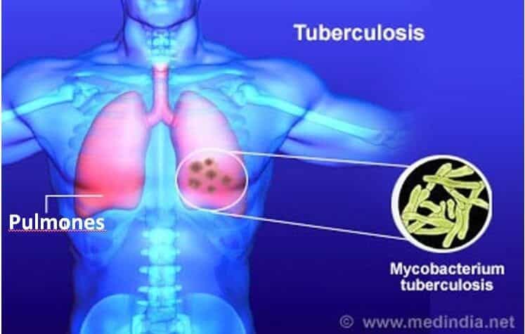 Los pulmones son uno de los órganos que con mayor frecuencia se afectan por la tuberculosis