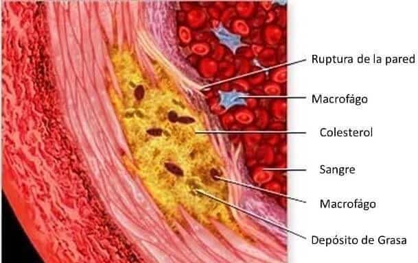 La arterioesclerosis determina la obliteración del vaso sanguíneo con la consiguiente disminución del flujo de sangre 