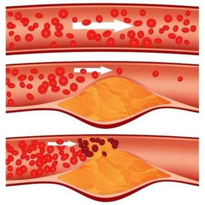 Arterioesclerosis: El Fantasma Oculto De La Enfermedad Cardiovascular