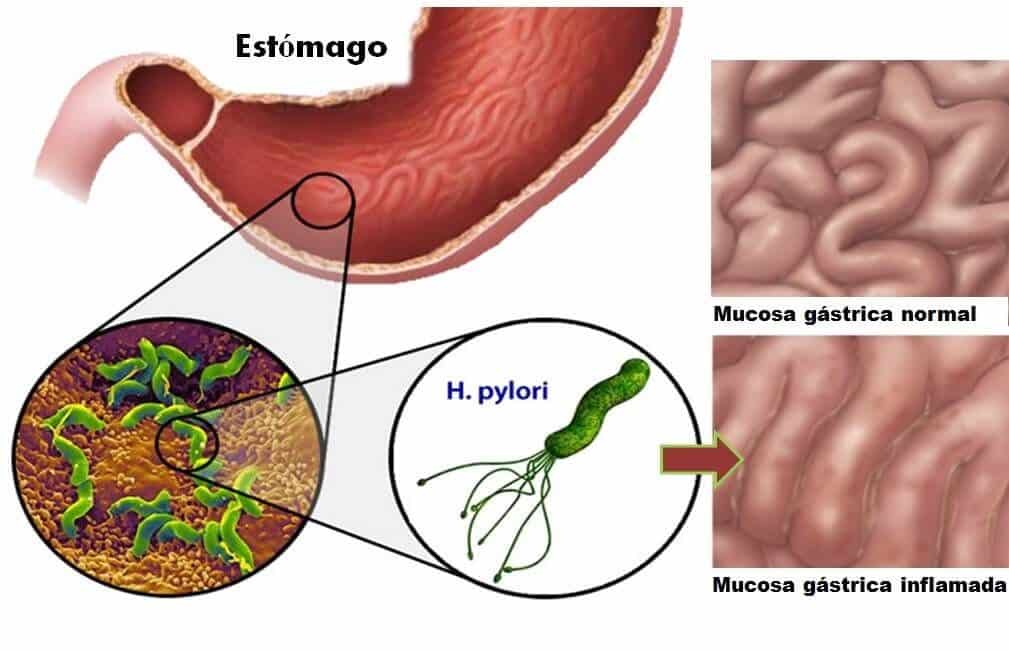 Tipos de bacterias en el estómago y síntomas