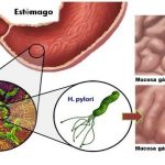 El H.pyloris es la causa más frecuente de gastritis