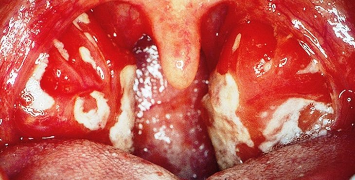Enrojecimiento de la boca y garganta en un paciente afectado con mononucleosis