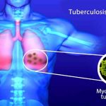 Afectación de los pulmones por las micobacterias