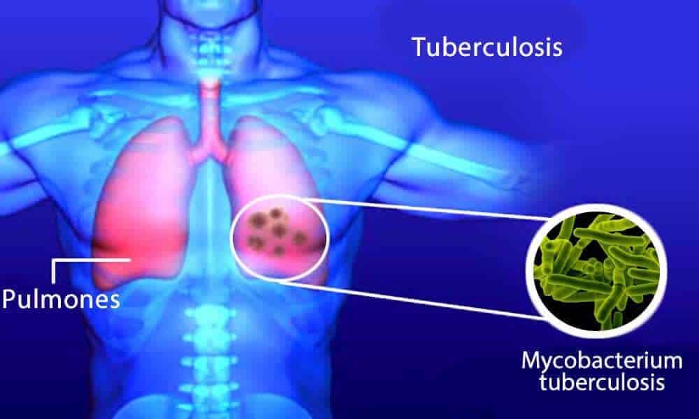 Los pulmones son uno de los órganos que con mayor frecuencia se afectan por la tuberculosis