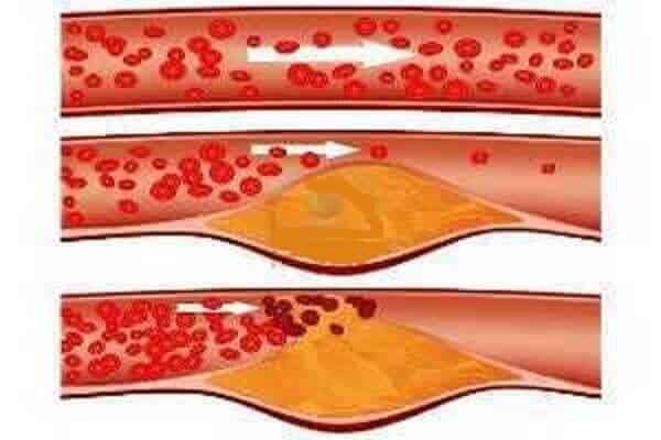 La arterioesclerosis de un vaso se evidencia con la formación de la placa de ateroma