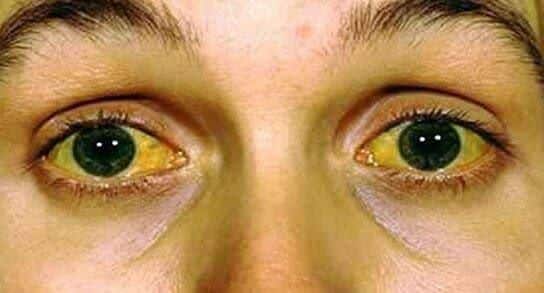 Una de las manifestaciones más llamativa de las hepatitis es la coloración amarillenta de la piel y mucosas