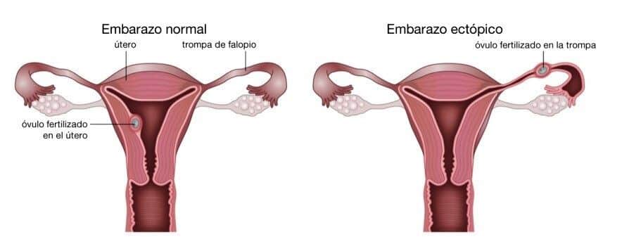 El Embarazo Ectópico Es Una Emergencia Médica