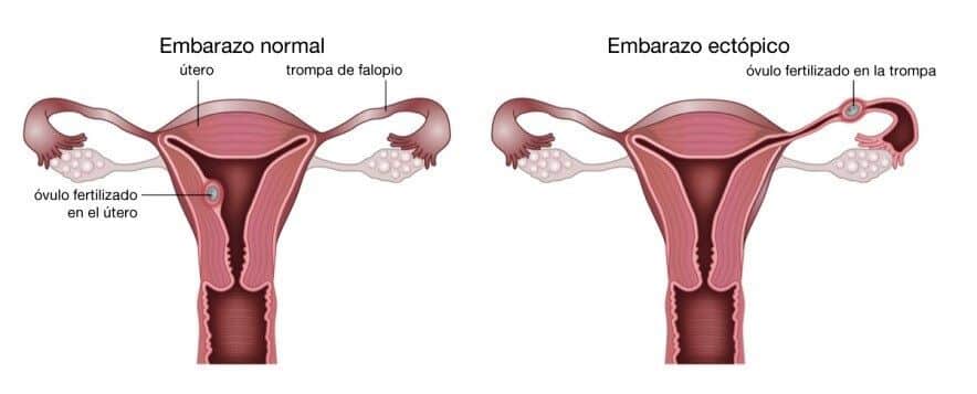Comparación entre el proceso de implantación del embrión en un embarazo normal con relación a uno ectópico