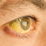 Ojos y piel amarilleados