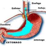 El reflujo gastroesofágico se produce por pérdida del control de las válvulas existentes entre estómago y esófago
