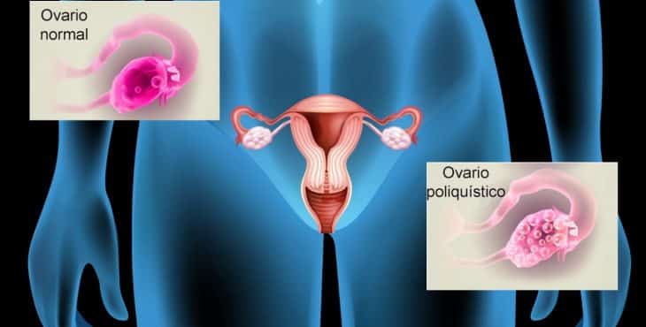 Los ovarios poliquísticos tienen bolsas llenas de fluidos