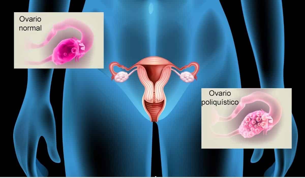 Los ovarios poliquísticos tienen bolsas llenas de fluidos