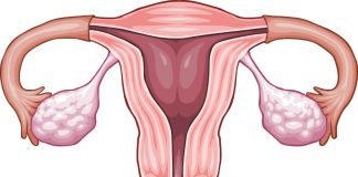 síntomas del cáncer de cuello uterino