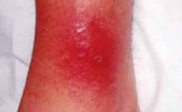 La celulitis es una infección común de los tejidos blandos que se encuentran por debajo de la piel y ocurren frecuentemente en las piernas
