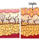 Celulitis infeccion