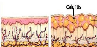 bacteria celulitis