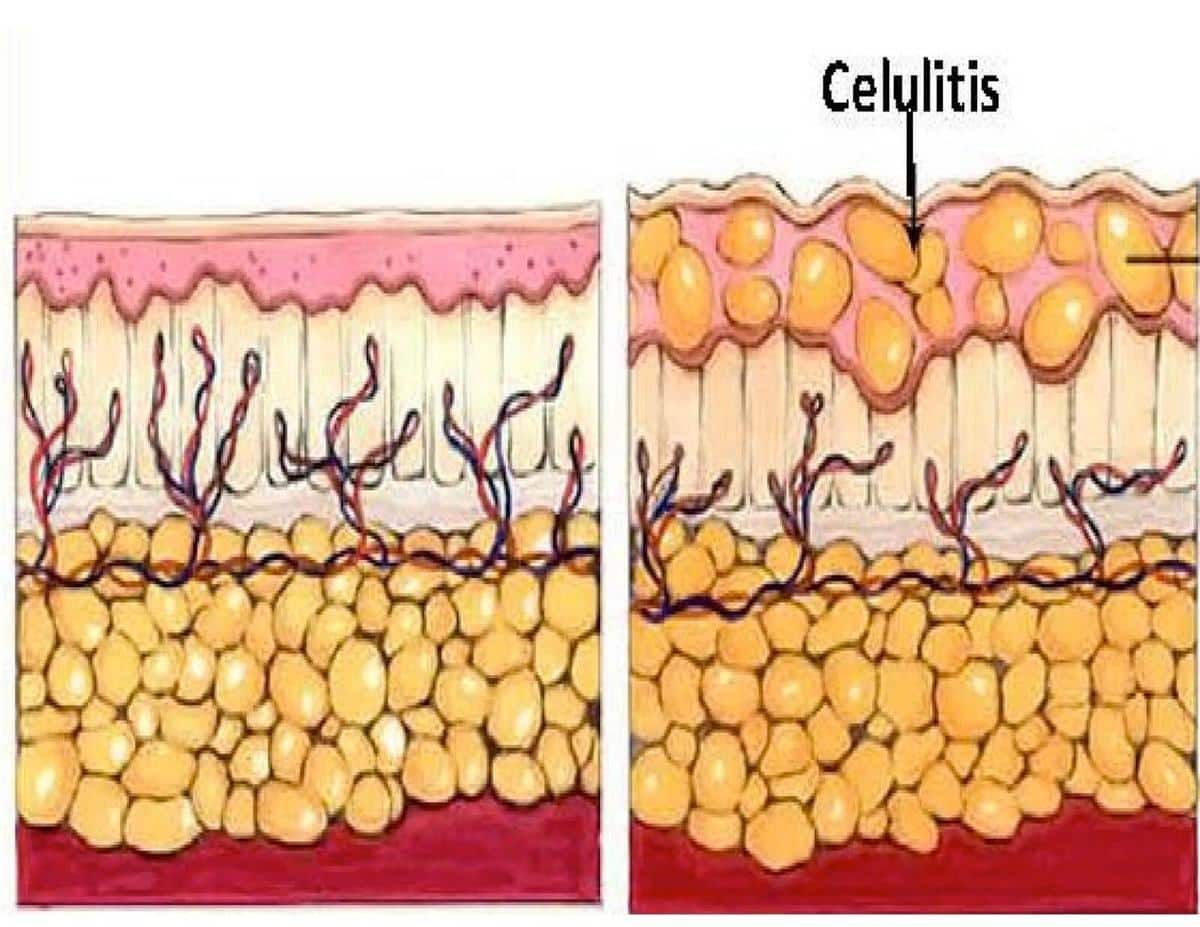 Celulitis, infecciones de la piel