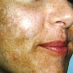 Melasma o manchas en la piel
