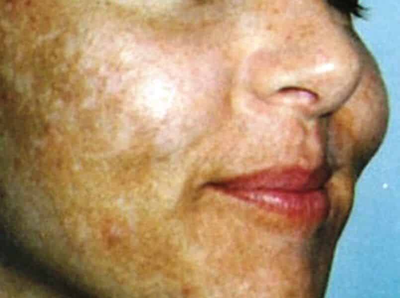 Las típicas manchas en la cara, mejillas, el puente de la nariz, frente, barbilla, y por encima de su labio superior que van de color café a grisáceos son expresión del melasma o cloasma, desorden común de la piel.
