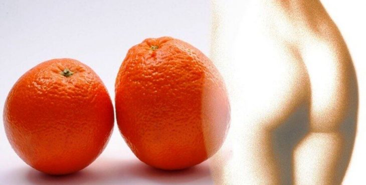 La piel de naranja es una de las manifestaciones de la celulitis