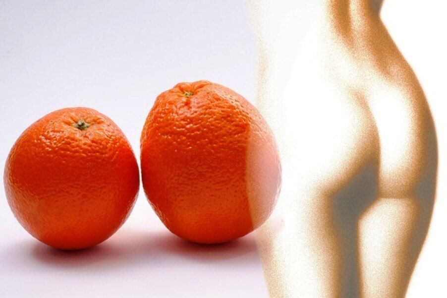 La piel de naranja es una de las manifestaciones de la celulitis