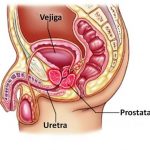 Prostatitis (2)