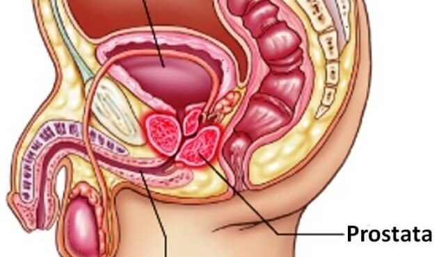 La prostatitis es la inflamación de la próstata, glándula en forma de nuez localizada por debajo de la vejiga y delante del recto y que rodea la uretra 
