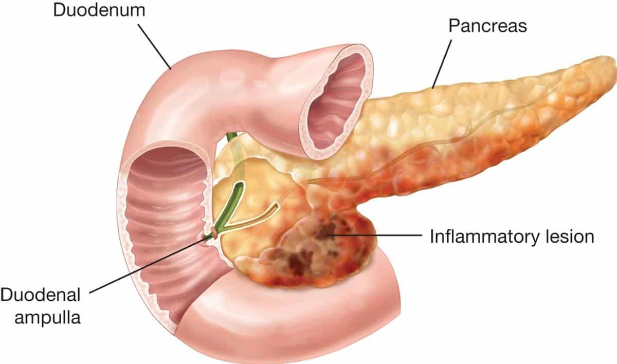 tipos de pancreatitis
