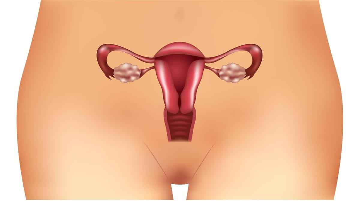 Síndrome de ovario poliquístico: causa frecuente de infertilidad