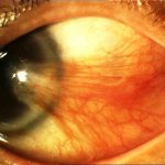 Carnosidad en el ojo llamada Pterygium