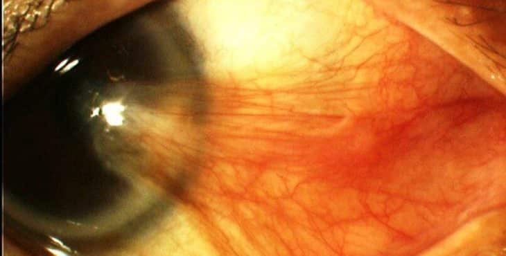 Un pterigio es la carnosidad de tejido benigno que se forma en la conjuntiva y cubre la parte blanca del ojo y potencialmente puede dispersarse hacia la córnea. 