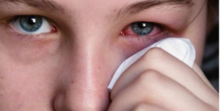 La irritación de la conjuntiva, es decir de la parte blanca del ojo, es conocida como conjuntivitis y puede estar causada la infección de virus o bacterias o por alergia