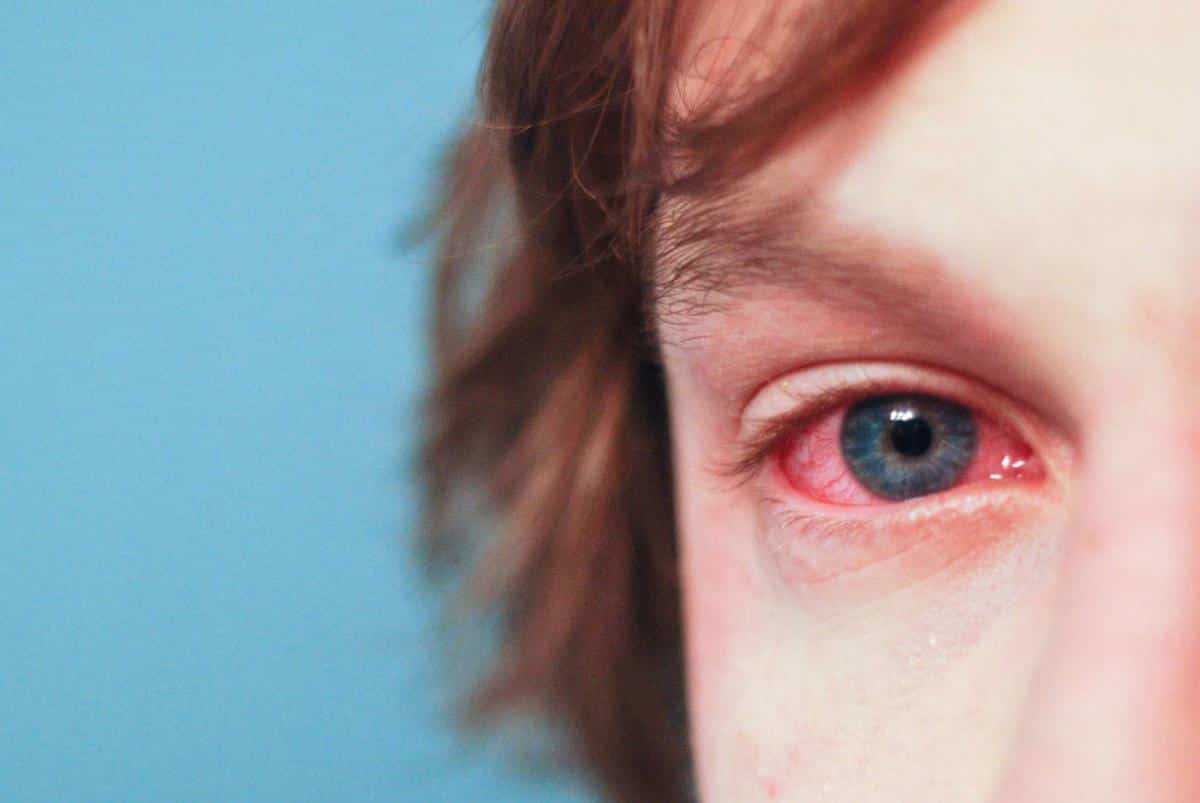 ¿Un ojo rojizo? Piensa en conjuntivitis