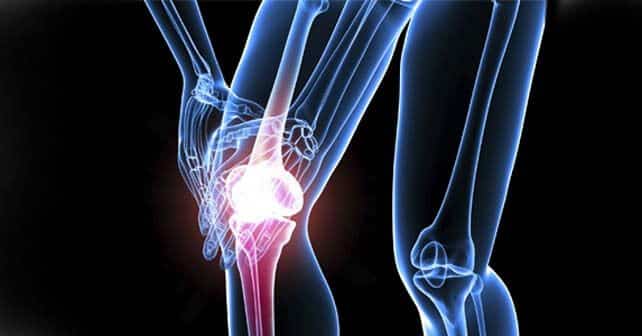 Se reconocen tres tipos de cáncer de huesos y uno de ellos es el osteosarcoma que ocurre habitualmente en la parte superior del brazo o en la rodilla.