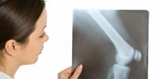 Se puede diagnosticar el cáncer de huesos a través de los Rayos X