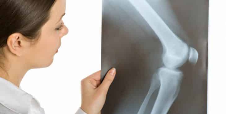 Se puede diagnosticar el cáncer de huesos a través de los Rayos X