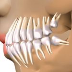 Las muelas del juicio no son más que el tercer molar, denominado comúnmente cordal