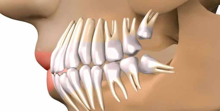 Al carecer del suficiente espacio en la cavidad bucal, las muelas del juicio suelen empujar los dientes aledaños en su esfuerzo por salir