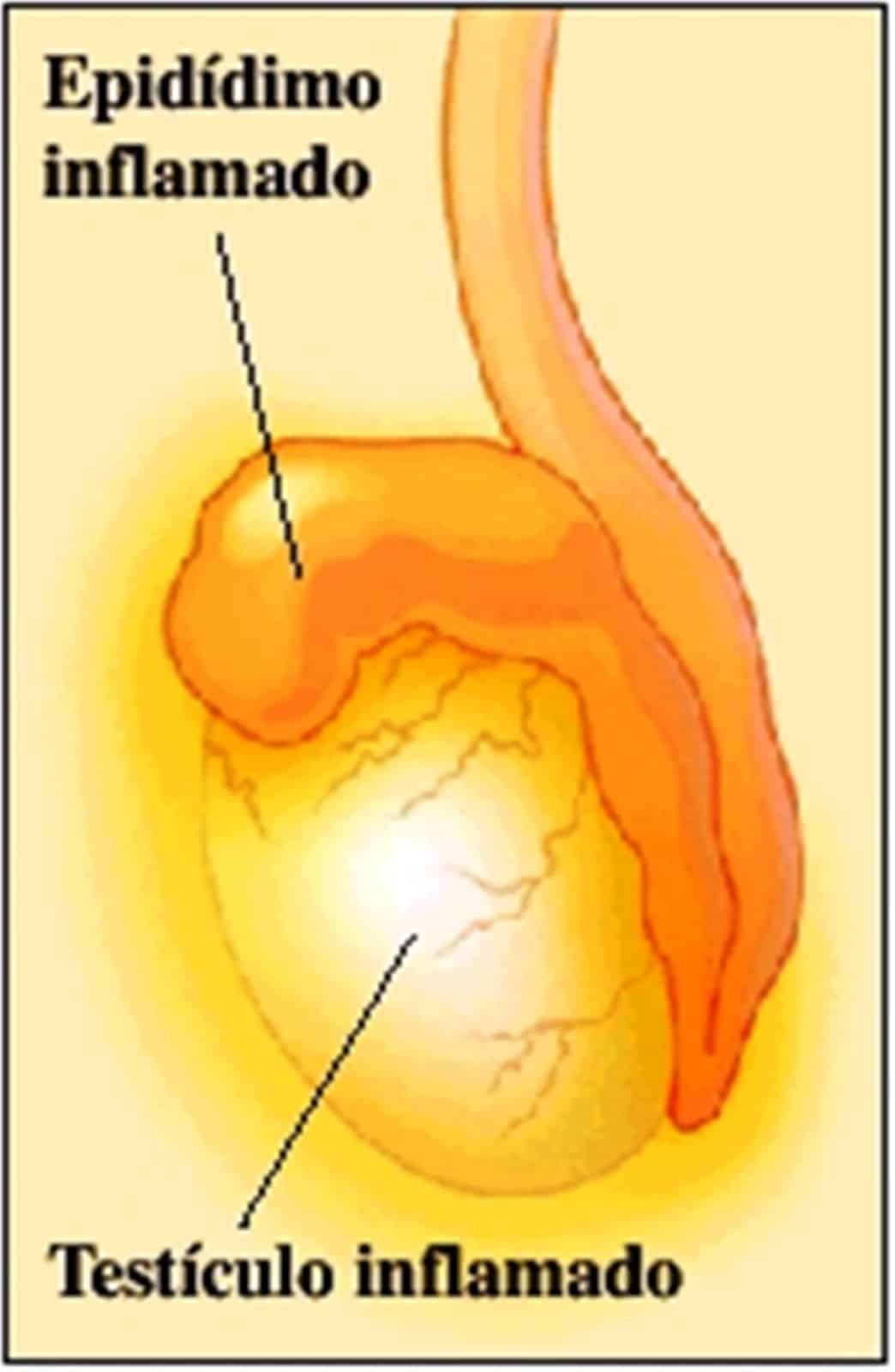 La orquiepididimitis conlleva la inflamación de testículos y epidídimo
