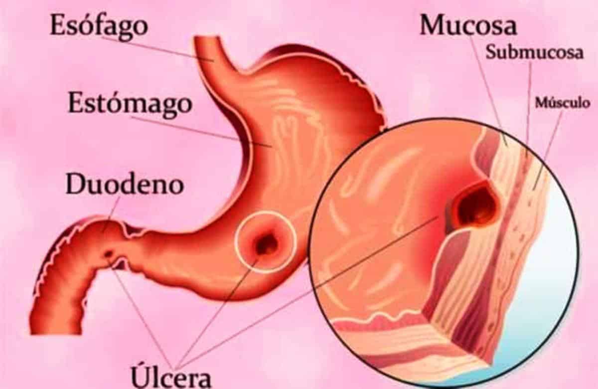 La úlcera de estómago se conoce también como úlcera gástrica; úlcera de tipo gástrico o úlcera péptica