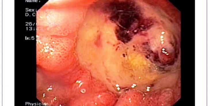 La úlcera de estómago es una zona en carne 