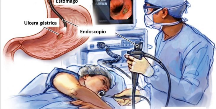 La endoscopia sirve para diagnosticar la presencia de úlcera de estómago