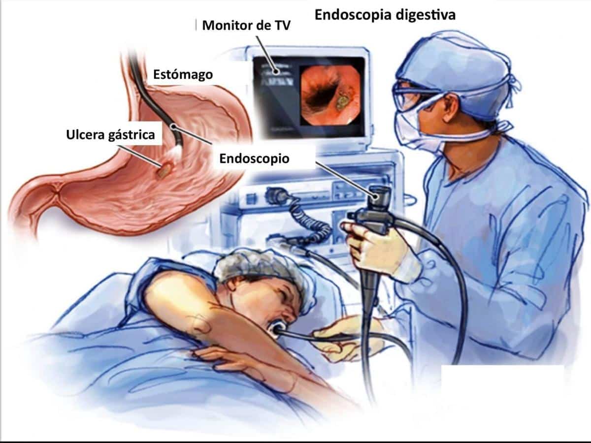 La endoscopia sirve para diagnosticar la presencia de úlcera de estómago