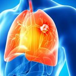 sintomas-de-cancer-de-pulmon