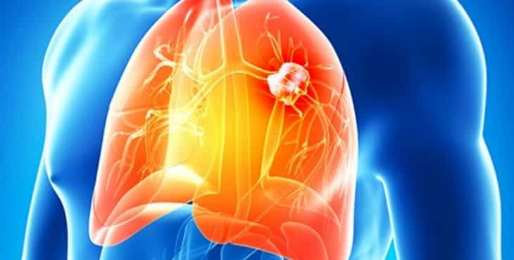 El cáncer de pulmón se manifiesta por tos que se acompaña de sangramiento 