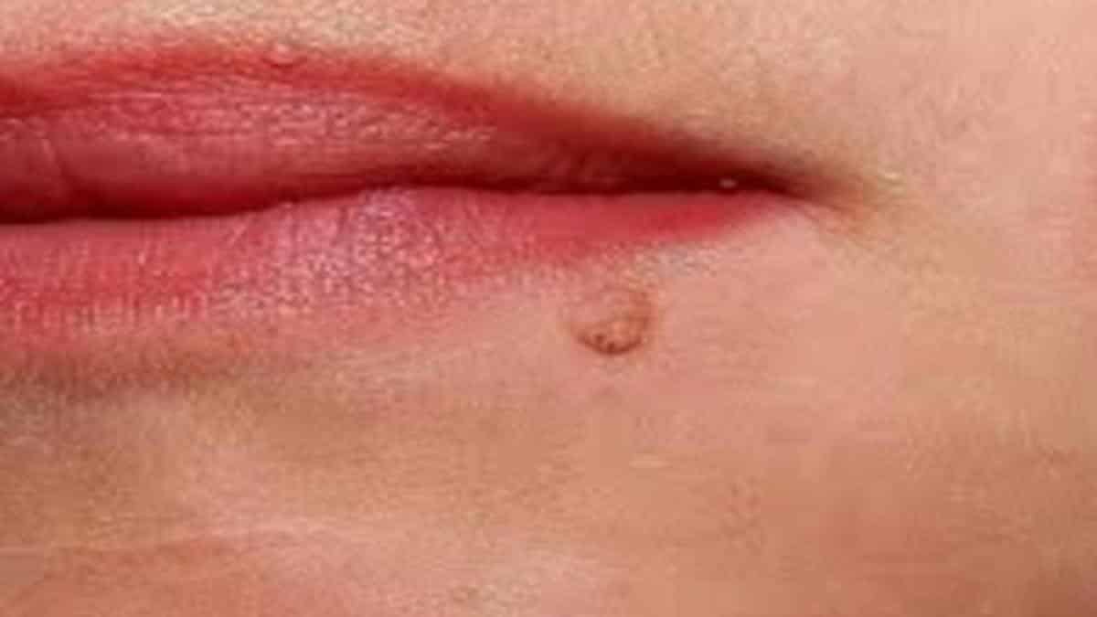 Las verrugas son producidas por el virus del papiloma humano pueden estar localizadas alrededor de la boca