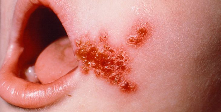 El impétigo es una de las enfermedades de la piel más comunes en niños