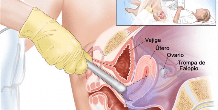El diagnóstico del cáncer de ovarios en muchas ocasiones se realiza de forma accidental