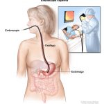 3-Endoscopia vias digestivas altas